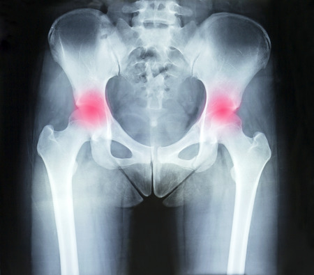 Film x-ray pelvis and arthritis both hip, marking in red colorの写真素材