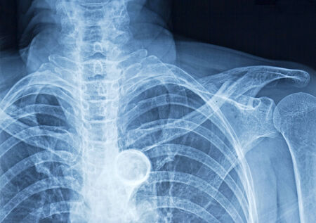 Film x-ray human's chest, rib, spine and tracheaの写真素材