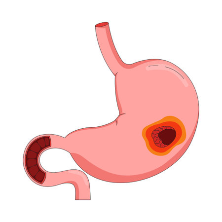 Human stomach with peptic ulcer 2D vector illustration. Anatomical organ inflammation. Digestive disease. Gastrointestinal tract wound flat object isolated on white background. Colorful cartoon imageのイラスト素材