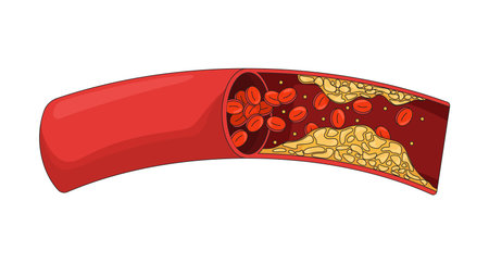 Cholesterol plaque obstructing blood flow 2D vector illustration. Impeding red blood cell circulation. Coronary artery disease flat object isolated on white background. Colorful cartoon imageのイラスト素材