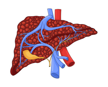 Human liver with cirrhosis and damaged nodular tissue 2D vector illustration. Hepatic disease. Internal organ tumor. Fibrosis pathology flat object isolated on white background. Colorful cartoon imageのイラスト素材