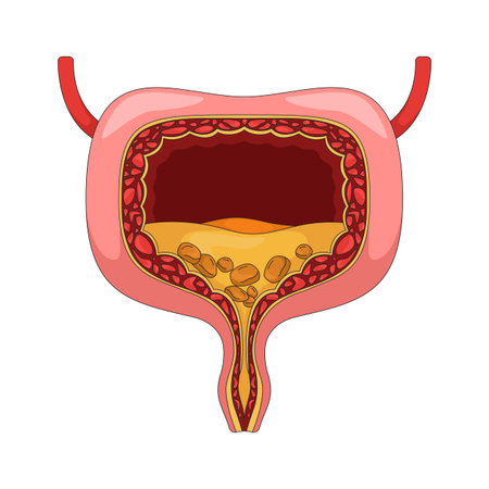 Human bladder cross-section with urinary stones 2D vector illustration. Internal organ blockage. Mineral buildup. Urological issue flat object isolated on white background. Colorful cartoon imageのイラスト素材