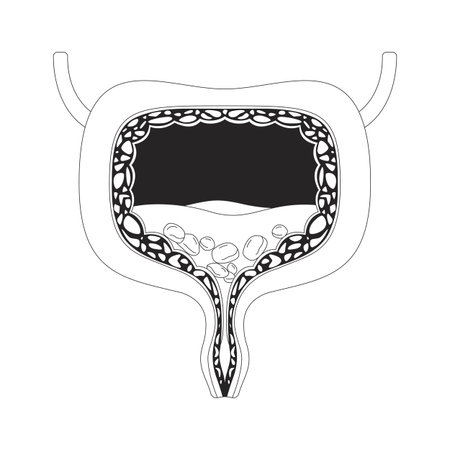 Human bladder cross-section with urinary stones outline illustration. Internal organ blockage. Mineral buildup. Urological issue 2D line object isolated on white. Monochrome vector ink linear imageのイラスト素材