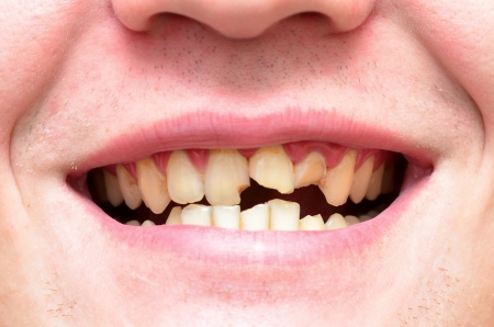 young man with a teeth broken and rottenの写真素材