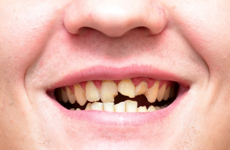 young man with a teeth broken and rottenの写真素材