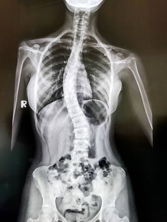 X-ray images of patients with bone problems.の写真素材