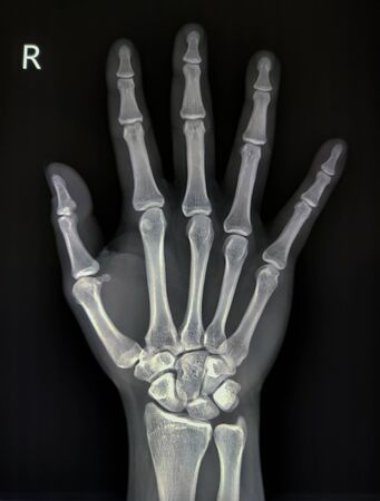 X-ray images showing the right hand bone.の写真素材