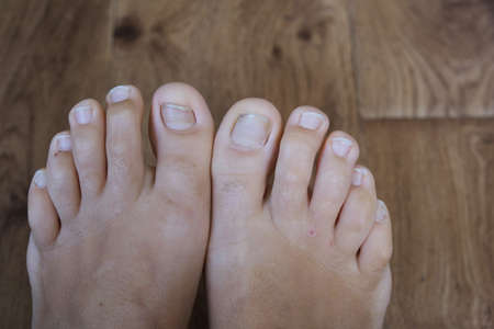 Women's nails without a pedicure. Lack of nutrients. Close-up. Without a face.