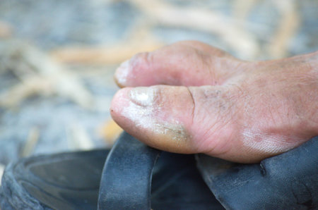 Psoriasis, Dermatitis. Foot Callosity. dry dehydrated skin on the heels feet with callusesの写真素材