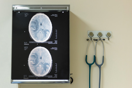 CT scan of brain on the x-ray film illuminators on the wall with stethoscopes