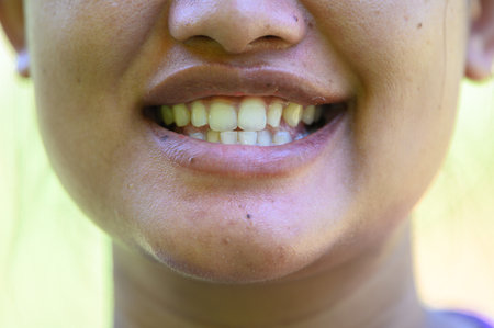 Smiling woman.Open mouth. See teeth.See teeth that are not aligned.Unattractive smile