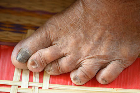 withered feet of old woman, withered tan skin, healthy and long live concept
