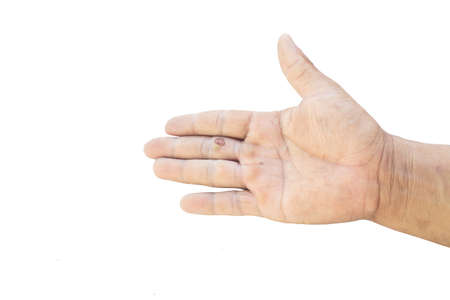 Hand wound, isolated on white background.の写真素材