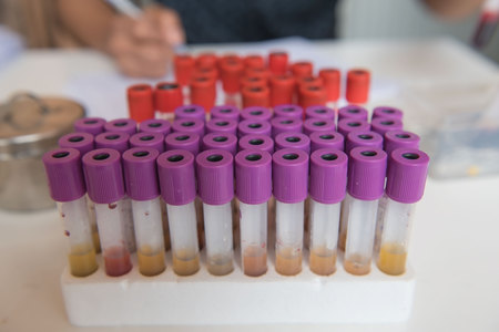 sample blood tube from patient  in Laboratory .の写真素材