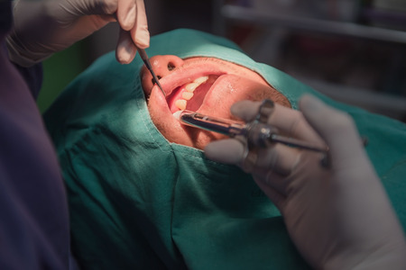 Anesthesia for tooth extraction by the dentist. Dentistry in hospital.の写真素材