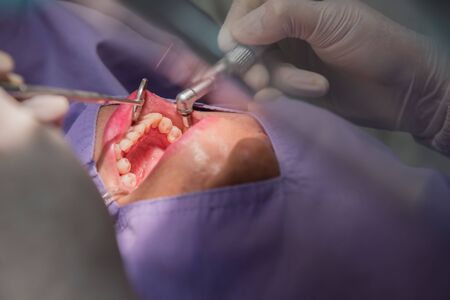 Teeth cleaning by the dentist. Dentistry in hospital.