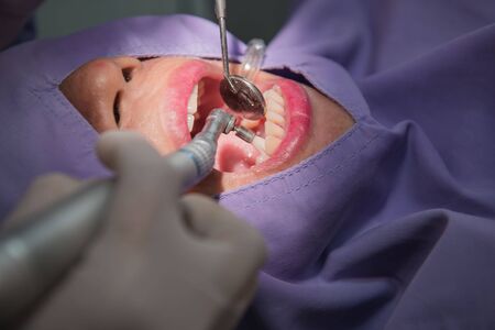 Teeth cleaning by the dentist. Dentistry in hospital.の写真素材