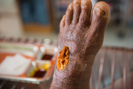 closeup  infection wound in the foot of patients .の写真素材
