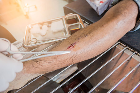 The wound stitched  in the leg  by doctor in the hospital. Accidental wounds .の写真素材