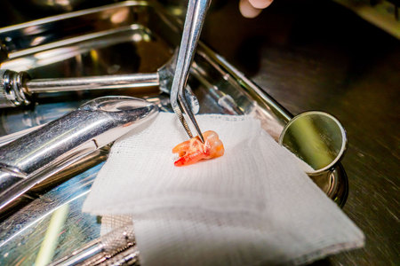 Loss of teeth from tooth extraction by the dentist. Dentistry in hospital.の写真素材