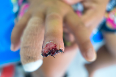wound sutures in the finger of patients in the hospital.の写真素材