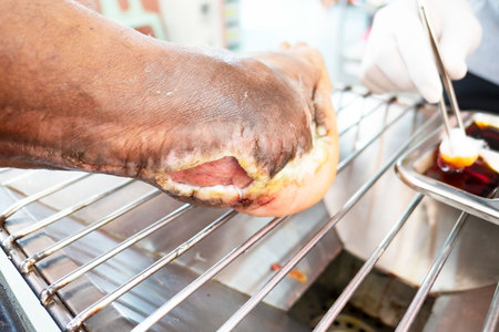 closeup  infection wound in the foot of patients .