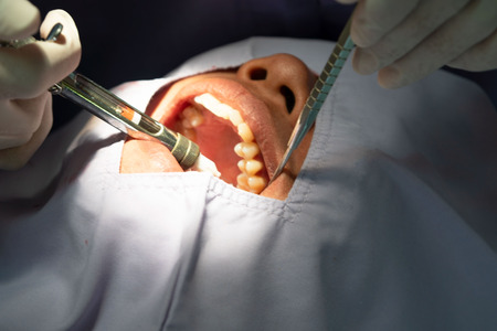 Anesthesia for tooth extraction by the dentist. Dentistry in hospital.の写真素材