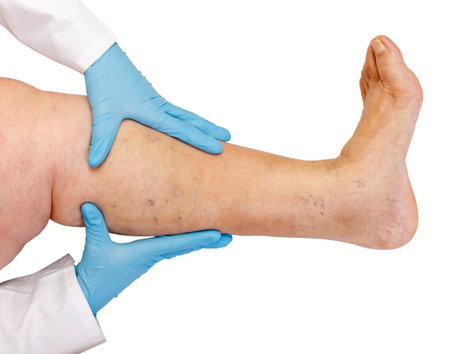 Lower limb vascular examination because suspect of venous insufficiencyの写真素材