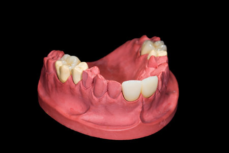 Dental ceramic crowns on gypsum model on isolated black background