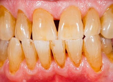 Close up photo of porcelain, zirconia teeth in human mouthの写真素材