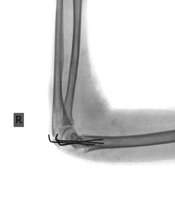 broken arm with screwの写真素材