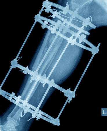 Broken tibia and fibula Xrayの写真素材