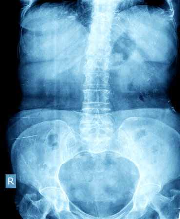 abdomen xray