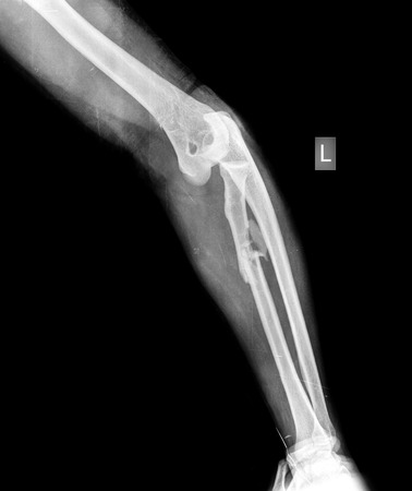 broken armの写真素材