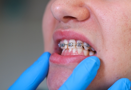 Close up of a dental braces at a dental clinicの写真素材