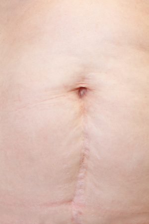 Close-up of a woman with a cesareanの写真素材