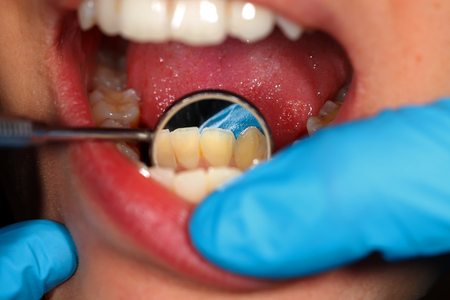 Close up of a patient's mouth at a dental clinicの写真素材
