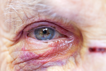 Close up picture of an elderly woman's injured eye & face - domestic violenceの写真素材