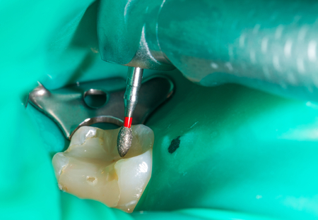 Close up picture of an endodontic procedure on a human toothの写真素材