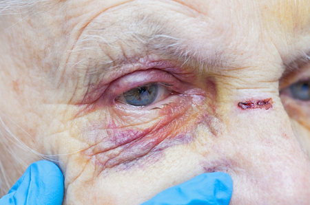 Close up picture of an elderly woman's injured eye and nurse's fingersの写真素材