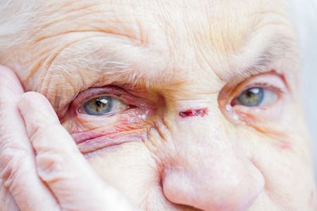 Close up picture of an injured elderly woman's eyes & faceの写真素材