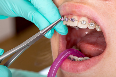Close up picture of young female's mouth. Dental braces - treatmentの写真素材