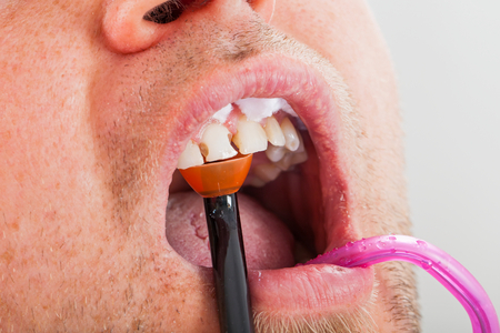 Dental treatment with polymerization lamp in oral cavity. Male patient close upの写真素材