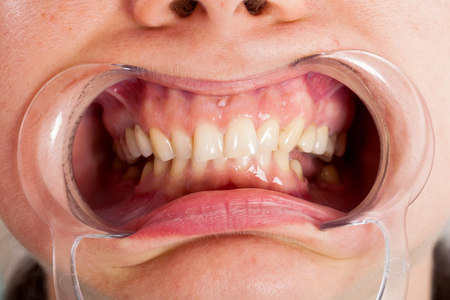 Close up picture of cheek retractor in patient's mouth. Dental treatmentの写真素材