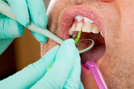 Man getting a front dental fillingの写真素材