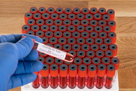 Coronavirus blood samples in biological laboratory - positive test results
