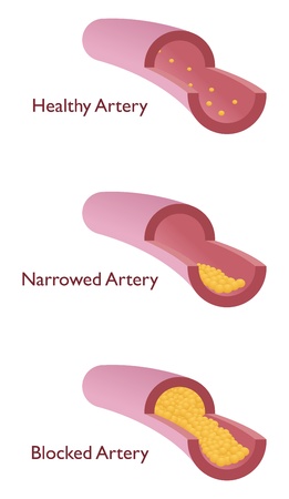 atherosclerosis with three kind of veinのイラスト素材