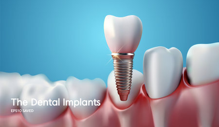 Dental implant with tooth on a blue background. 3d illustrationのイラスト素材