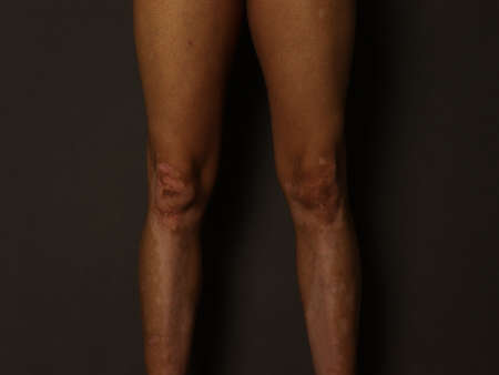 Legs of a woman with varicose veins on a dark backgroundの写真素材
