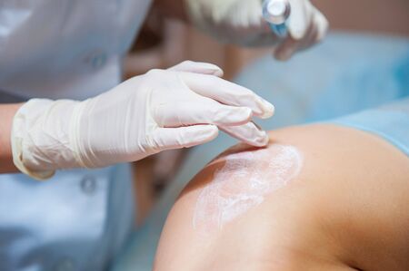 Application of anesthetic cream process after aesthetic laser correction procedure of scars and stretchs on the body in the medical clinic, beauty salon. Close up, selective focus.の写真素材